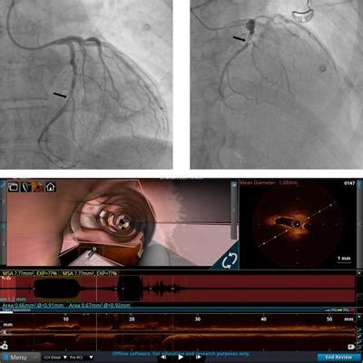 Frontiers Case Report Optical Coherence Tomography To Guide Pci Of