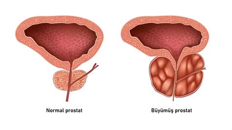 Prostat Nedir Tedavisi Nedir