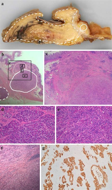 Figure2 A Macroscopic View Of The Tumor The Cut Surface Had A 2 Cm