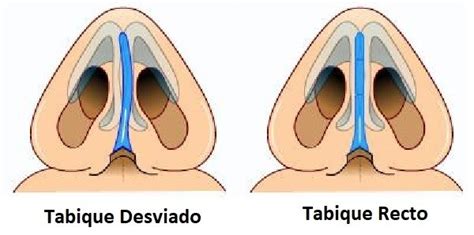 Tabique de la nariz desviado Síntomas consecuencias y tratamiento