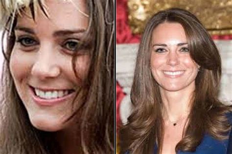 Kate Middleton before and after plastic surgery 13 | Celebrity plastic ...