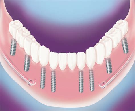 Implantate Dres Med Dent Lechl