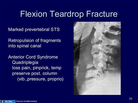 Gemc The Role Of Radiography In The Initial Evaluation Of C Spine Tr