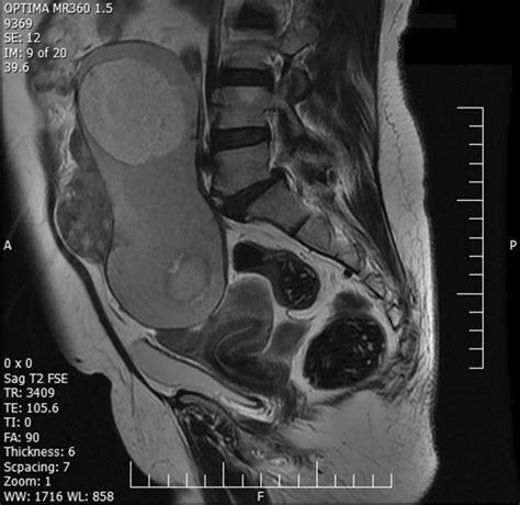 Sagittal T2 Weighted Fast Spin Echo Magnetic Resonance Imaging Image