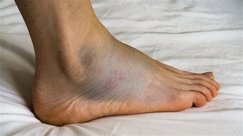 Understanding and Managing Leg Swelling: Causes, Symptoms, and ...