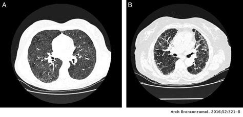 Farmers Lung Disease A Review Archivos De Bronconeumología