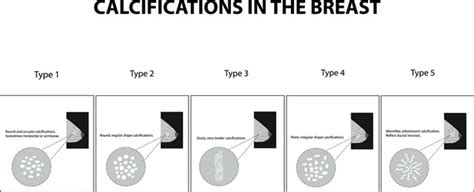 Classification Calcifications In The Mammary Gland