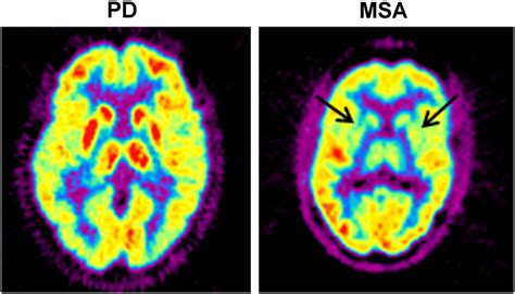 Imaging Approaches To Parkinson Disease Journal Of Nuclear Medicine