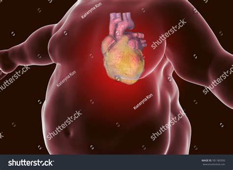 Heart Disease Person Obesity Conceptual Image Stock Illustration 781185550 Shutterstock