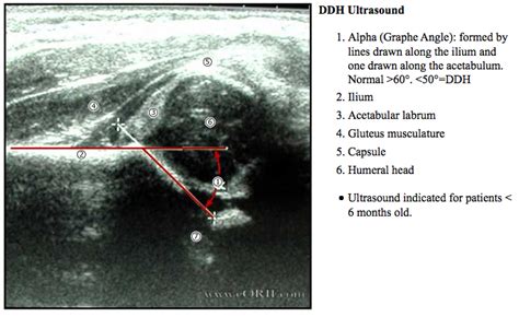 Developmental Dysplasia of the Hip | eORIF