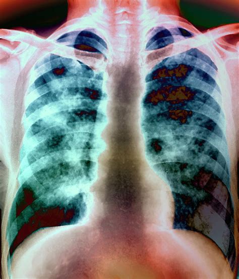 Lung Silicosis Photograph By Zephyrscience Photo Library Pixels