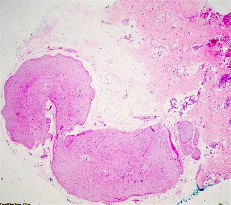 Plexiform Neurofibroma Gross