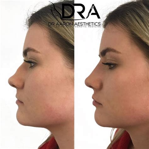 Non Surgical Rhinoplasty Purpose To Hide Bumps Straighten Your Nose