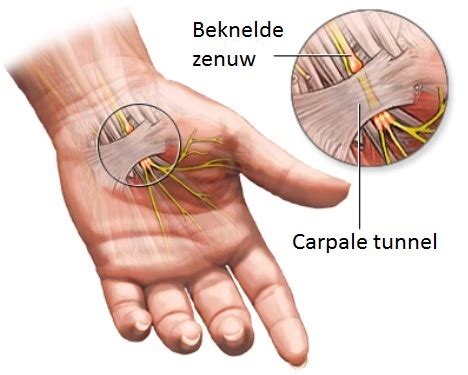 Carpaal Tunnel Syndroom Informatie Debraceshop Nl