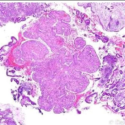 Endocervical Polyp Demonstrating Proliferating Glandular Epithelium And