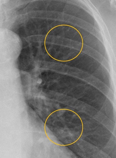 Mitral Stenosis Radiology Reference Article