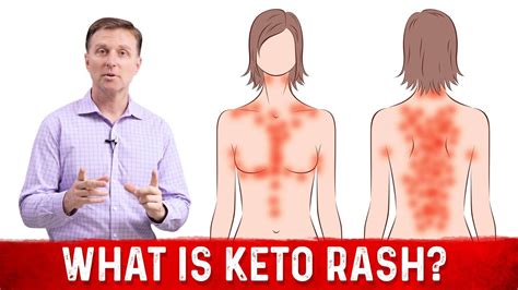 What Is Keto Rash Dr Berg Youtube