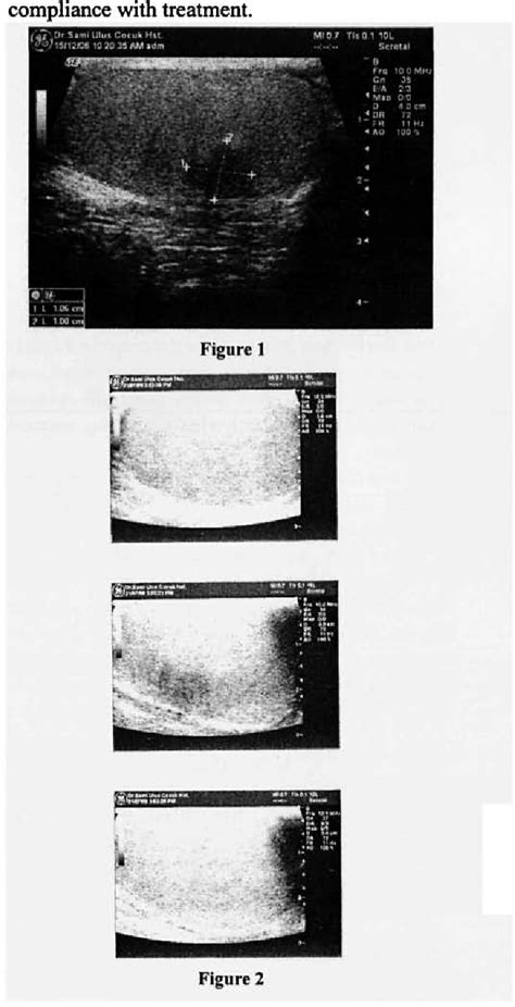 Figure 1 From Testicular Adrenal Rest Tumor In A Patient With 11β