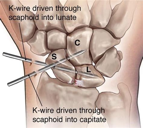 Scapholunate Ligament Repair With Capsulodesis Reinforcement Journal