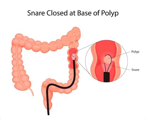 Eliminación de pólipos intestinales cúmulos de células dentro del colon