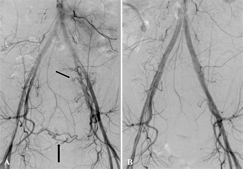 Digital Subtraction Angiography Dsa Images During Uterine Artery