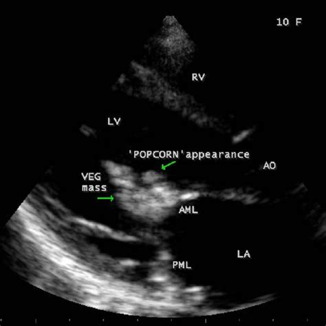 A Popcorn Like Vegetation Attached To The Anterior Mitral Leaflet Download Scientific