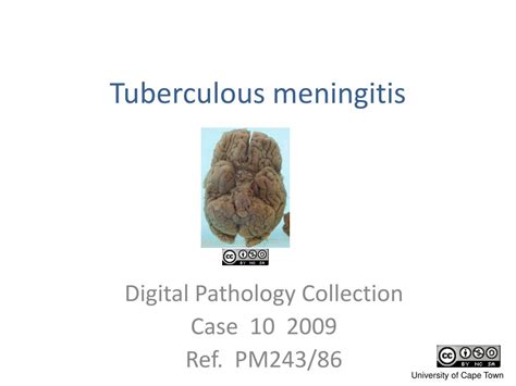 PPT - Tuberculous meningitis PowerPoint Presentation, free download ...