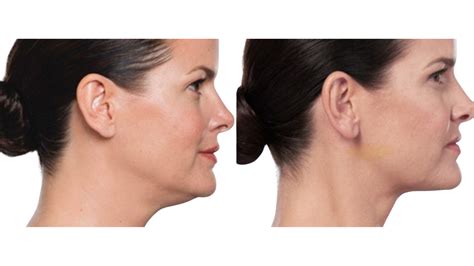 PCDC Double Chin Fat Reduction Ottawa Medispa Trainyards