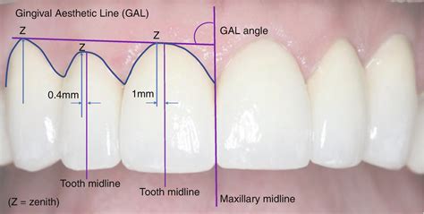 Gingival Zenith Point In Dentistry News Dentagama