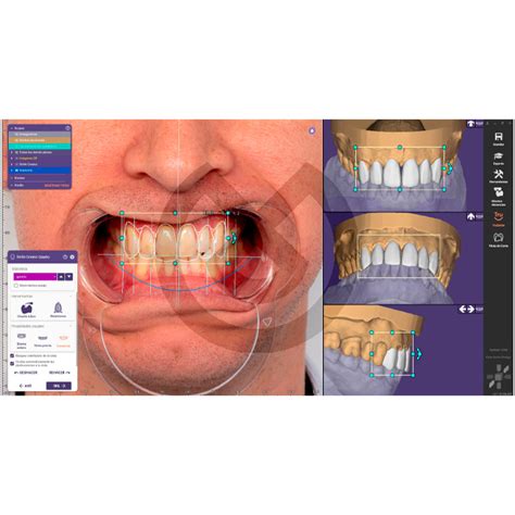 M Dulo Exocad Smile Creator Dise O De Sonrisas Klinikare