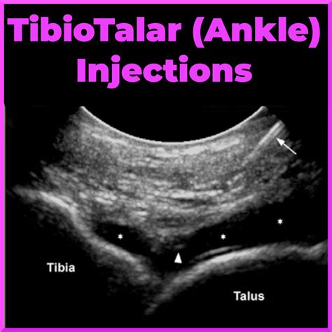 Tibiotalar Joint Injection Ultrasound Sports Medicine Review