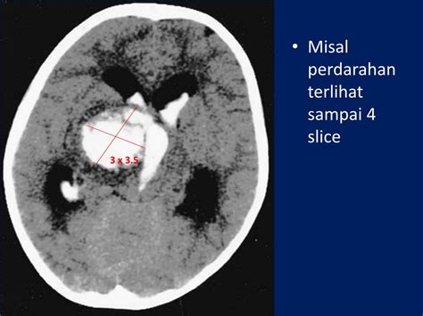 Ppt Melaporkan Hasil Ct Scan Kepala Pada Pasien Stroke Powerpoint