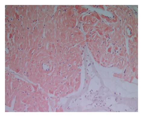 Sigmoid Colon Polypectomy Showing Benign Colonic Mucosa With