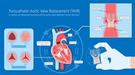 Treatment Of Aortic Stenosis Dr Raghu