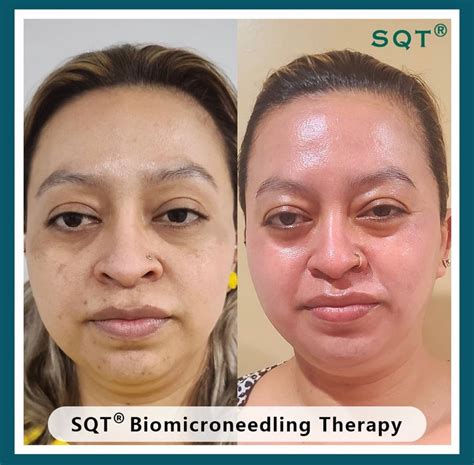 Sqt Bio Microneedling Dr Kara Cosmetic Clinic