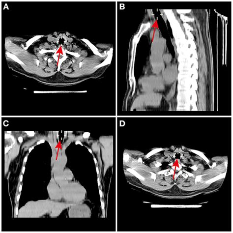 Frontiers Prediction Of Left Double Lumen Tube Size By Measurement Of