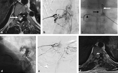 Percutaneous Embolization Of Spinal Epidural Arteriovenous Fistulae