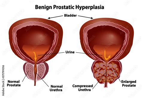 Prostate Normal And Enlarged Benign Prostatic Hyperplasia With Compressed Urethra Realistic