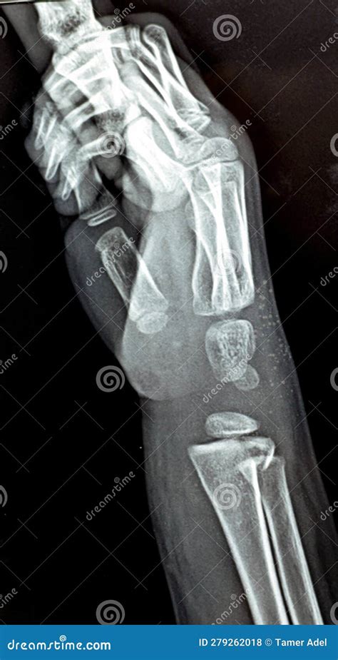 Plain X Ray Shows Avulsion Fracture Base Of The Distal Phalanx Of The