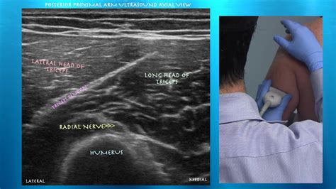 Ultrasound Of Normal Triceps Anatomy By Probeultasound YouTube