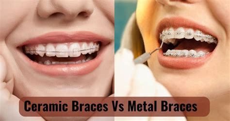 Ceramic Braces Vs Metal Braces What Should I Choose