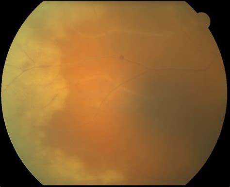 Classification Criteria For Acute Retinal Necrosis Syndrome American