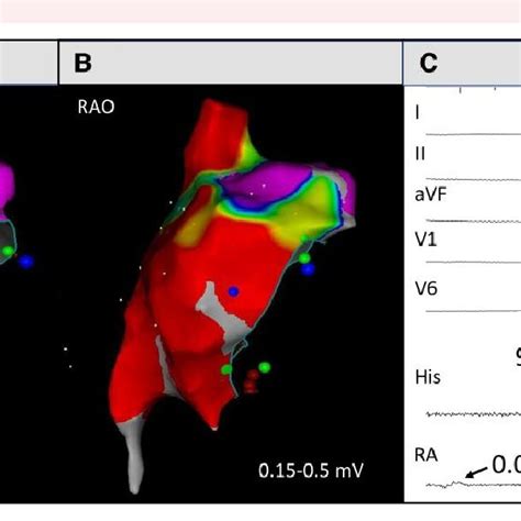 Electroanatomical Map Of The Right Atrium In Anteroposterior A And