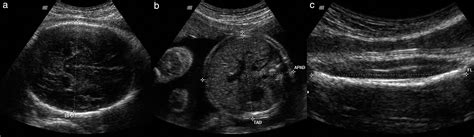 Biometry And Fetal Weight Estimation By Twodimensional And Three