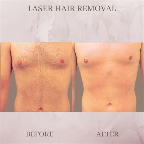 Laser Hair Removal - Eluma - Laser & Aesthetics