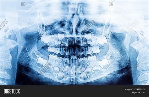 Children Dental X Ray Image And Photo Free Trial Bigstock