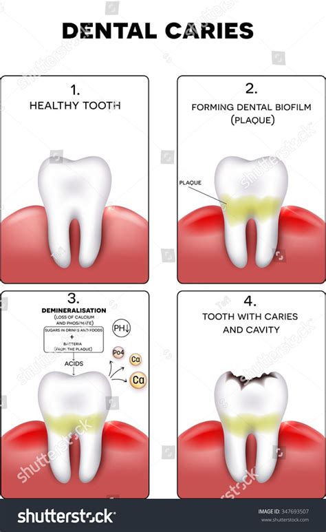 Dental Caries Formation Dental Plaque Loss Stock Vector Royalty Free