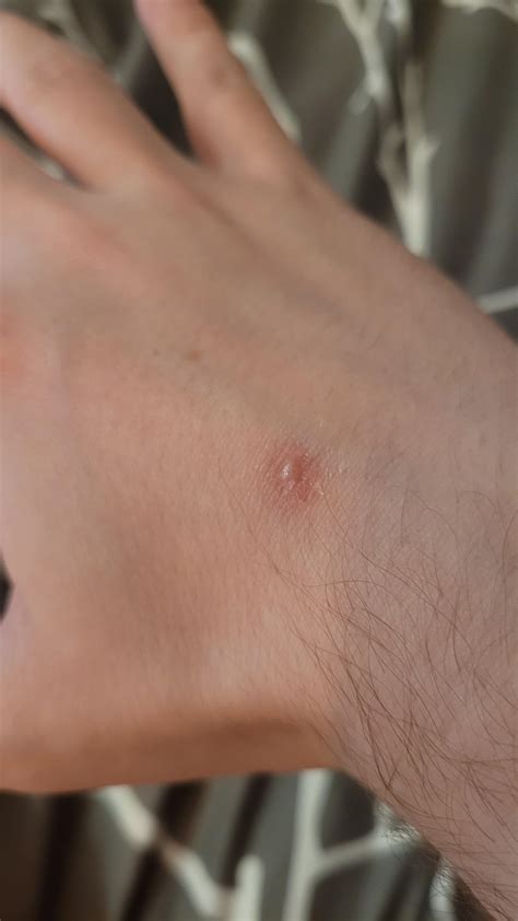 Cigarette Burn I Sustained 5 Months Ago Does Anyone Know If Itll Get