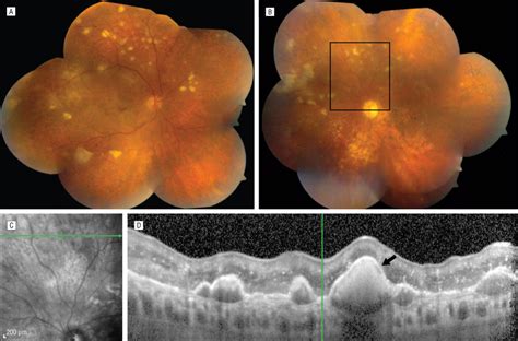 Intraocular Lymphoma Farabi Retina