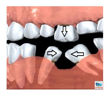 ODC Fact Loss Of One Or Two Teeth In A Segment Of Your Mouth Can Lead